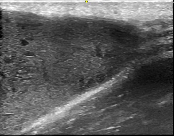 術前超音波検査④