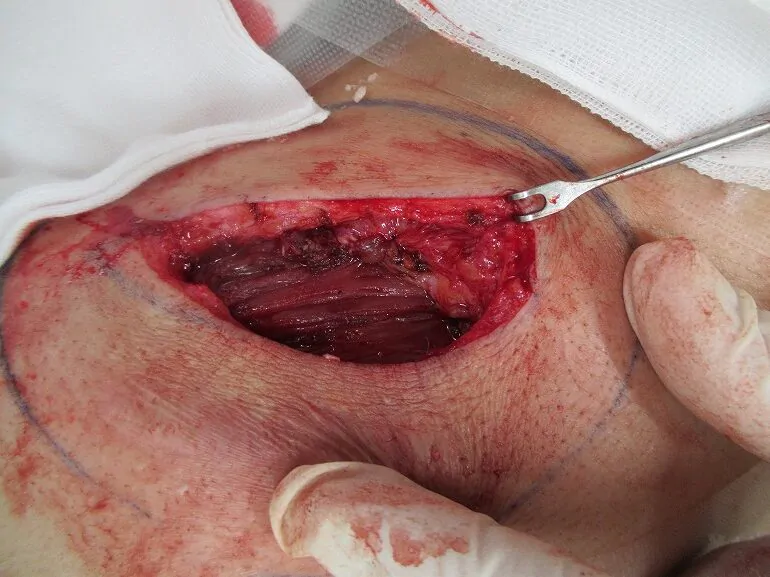 術中 ②被膜を完全に切除