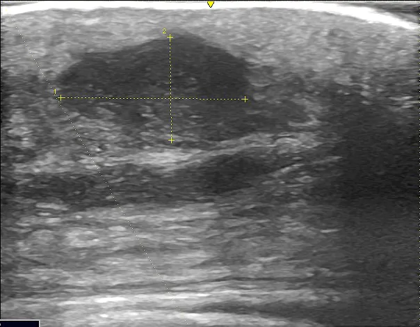 術前超音波検査