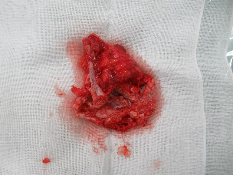 術中③摘出された被膜