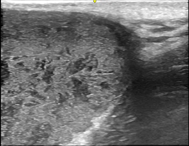 術前超音波検査②