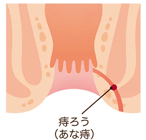 痔ろう（穴痔）