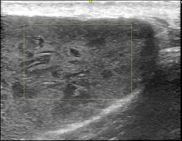 術前超音波検査①