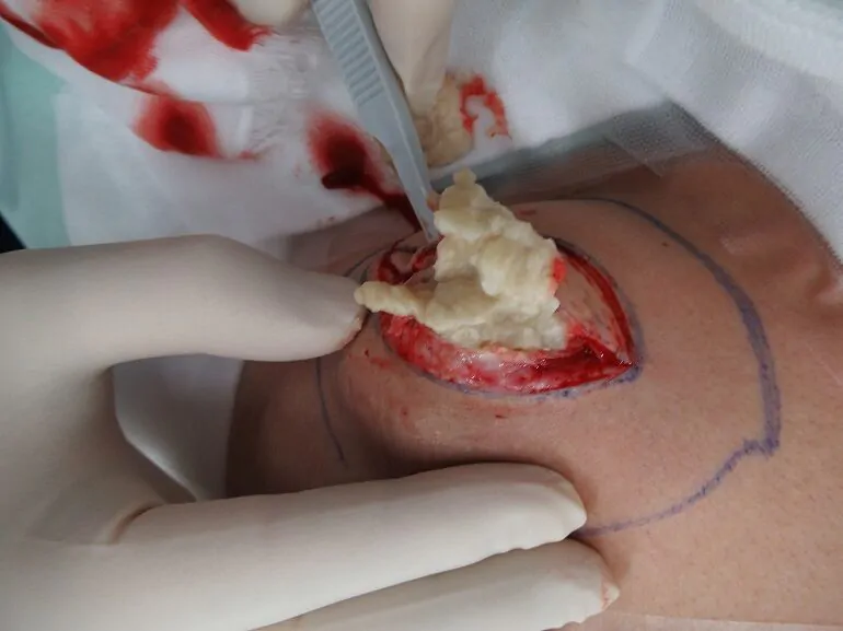 術中①切開で角質を排出