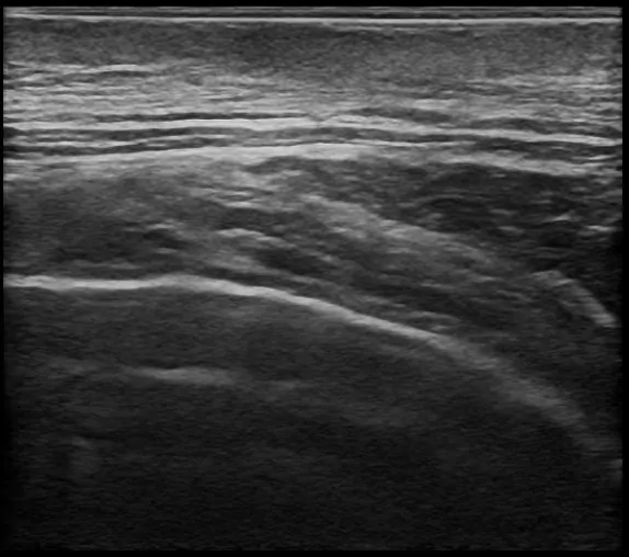 術後半年後の超音波検査