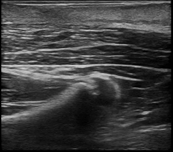 術後半年後の超音波検査