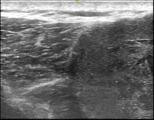 術前超音波検査③